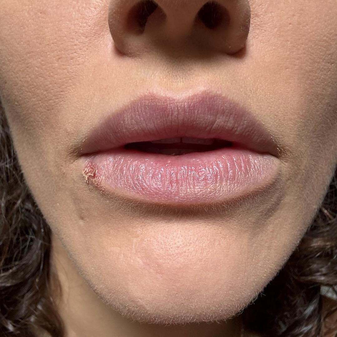 Me irritó los labios